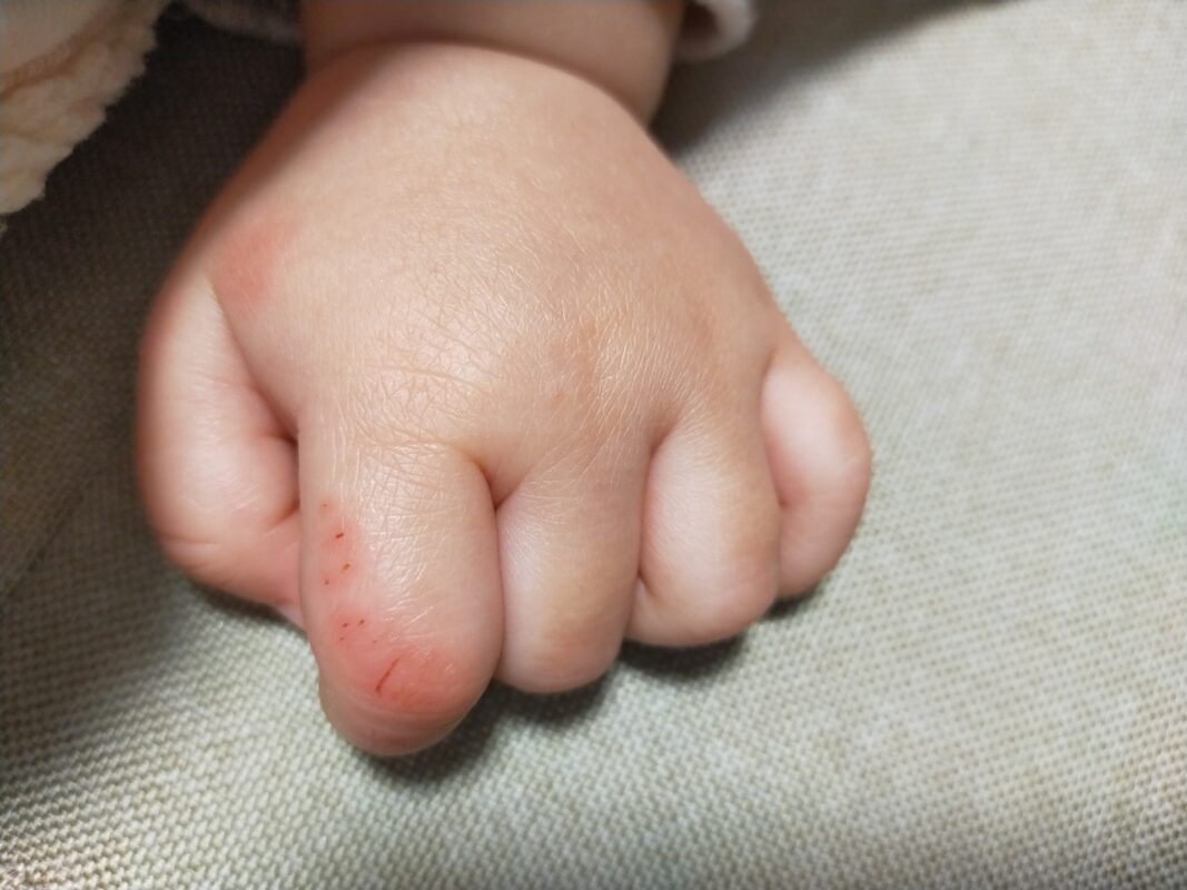 子供の手の傷